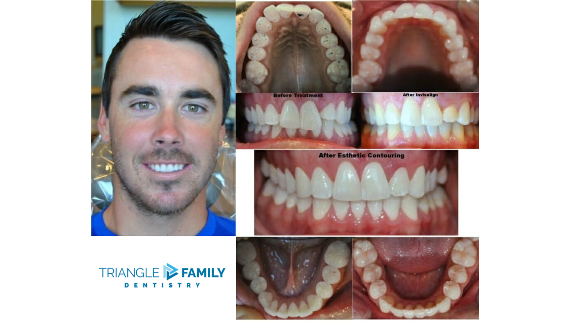 Smile Gallery - Before and After Dental Invisalign and Contouring at Triangle Family Dentistry