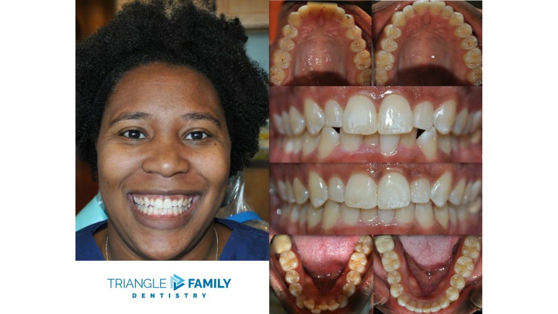 Smile Gallery - Before and After Dental Treatments at Triangle Family Dentistry