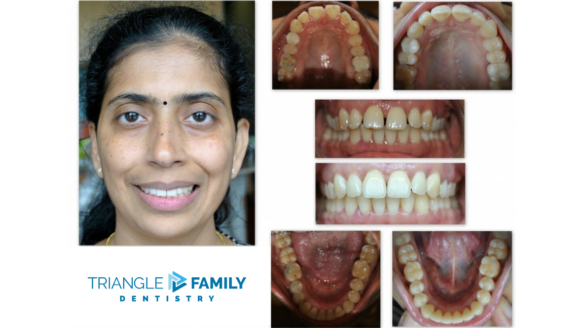 Smile Gallery - Before and After Dental Treatments at Triangle Family Dentistry