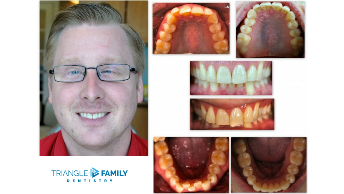 Smile Gallery - Before and After Dental Treatments at Triangle Family Dentistry
