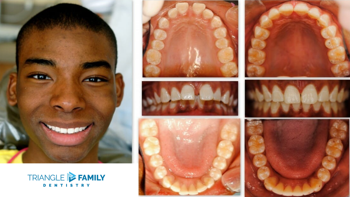 Smile Gallery - Before and After Dental Treatments at Triangle Family Dentistry