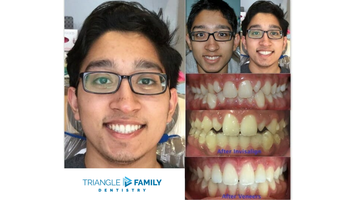 Smile Gallery - Before and After Invisalign at Triangle Family Dentistry
