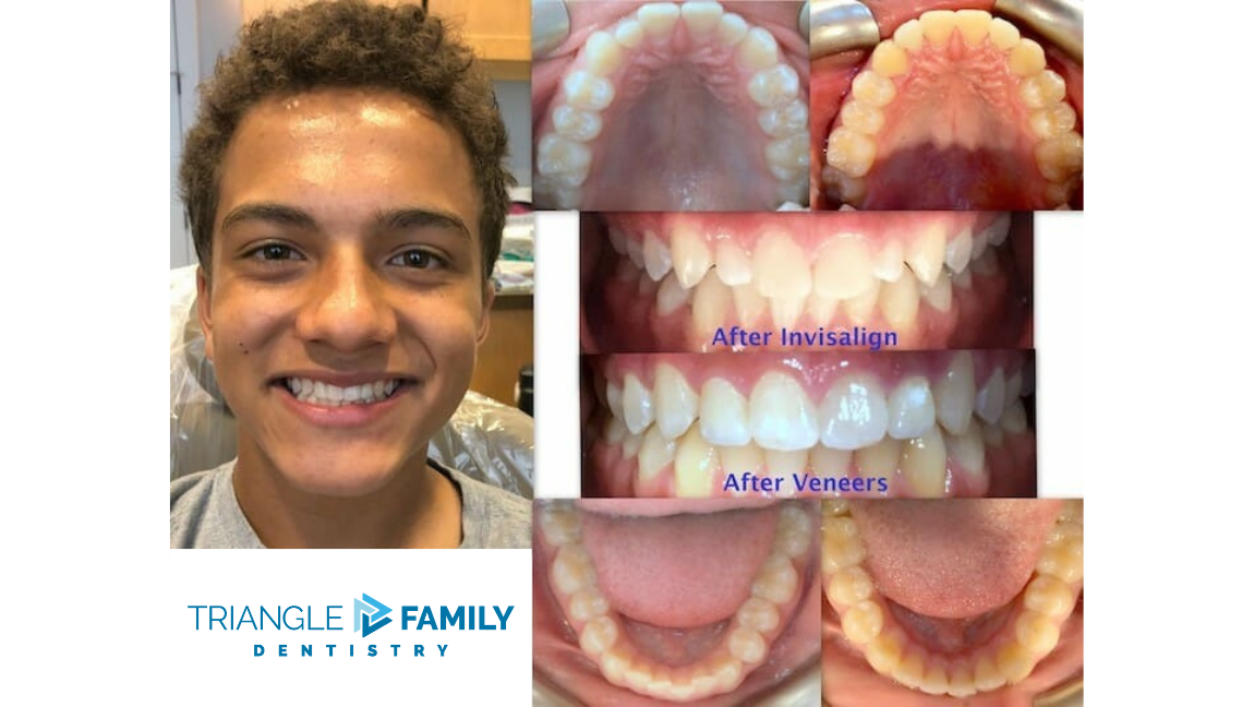 Smile Gallery - Before and After Dental Veneers at Triangle Family Dentistry