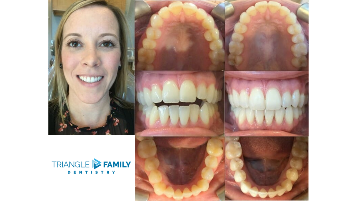 Smile Gallery - Before and After Dental Treatments at Triangle Family Dentistry