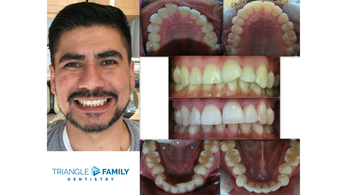 Smile Gallery - Before and After Dental Treatments at Triangle Family Dentistry