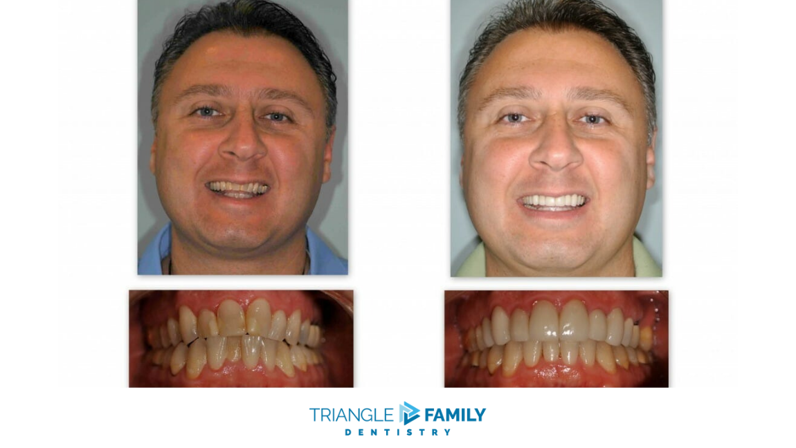 Smile Gallery - Before and After Dental Treatments at Triangle Family Dentistry