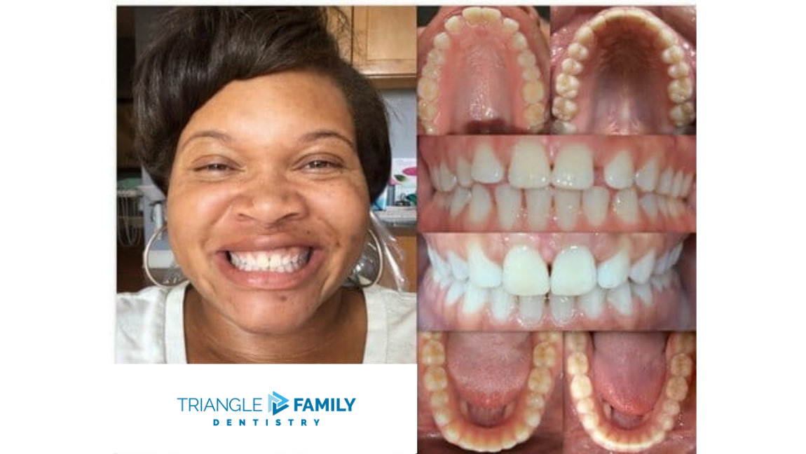 Smile Gallery - Before and After Dental Treatments at Triangle Family Dentistry