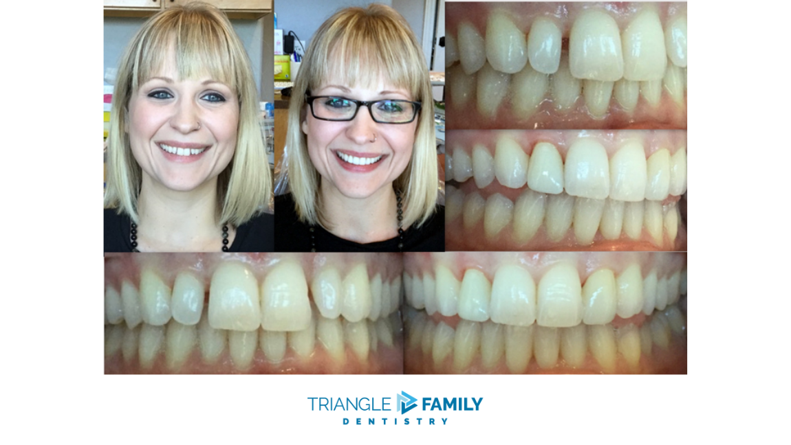 Smile Gallery - Before and After Dental Treatments at Triangle Family Dentistry