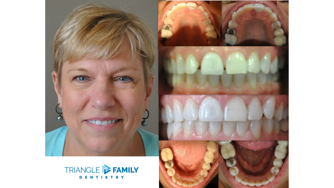 Smile Gallery - Before and After Dental Treatments at Triangle Family Dentistry