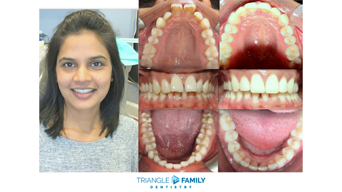 Smile Gallery - Before and After Dental Treatments at Triangle Family Dentistry