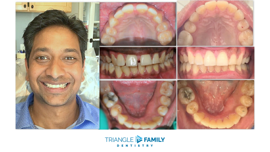 Smile Gallery - Before and After Dental Treatments at Triangle Family Dentistry