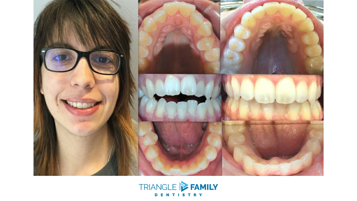 Smile Gallery - Before and After Dental Treatments at Triangle Family Dentistry