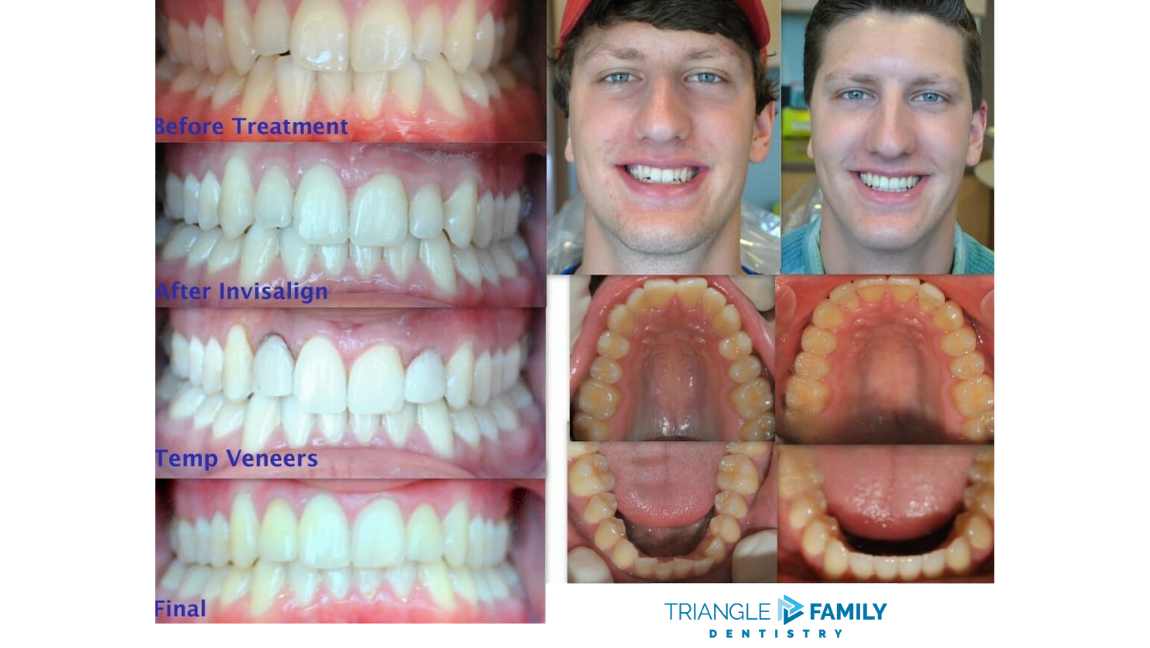 Smile Gallery - Before and After Invisalign and Veneers at Triangle Family Dentistry