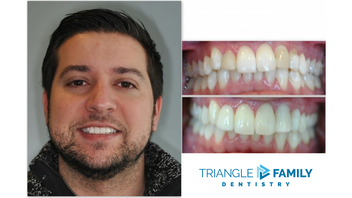 Smile Gallery - Before and After Dental Treatment at Triangle Family Dentistry