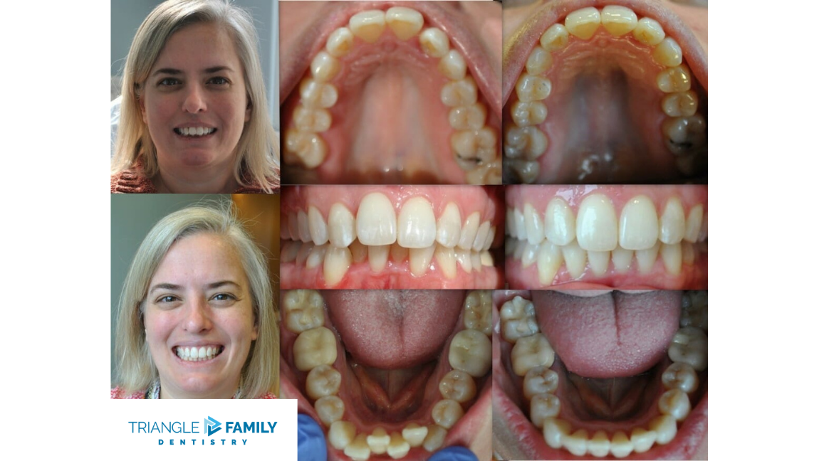 Smile Gallery - Before and After Dental Treatments at Triangle Family Dentistry