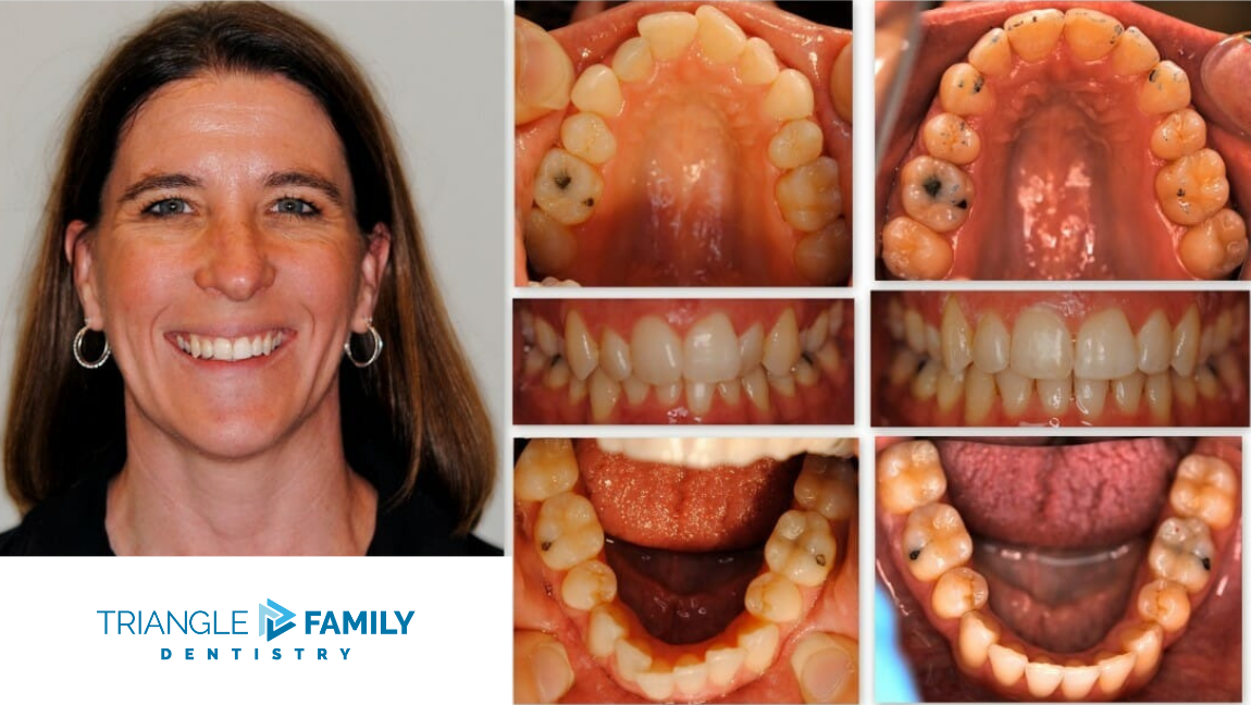 Smile Gallery - Before and After Dental Treatments at Triangle Family Dentistry