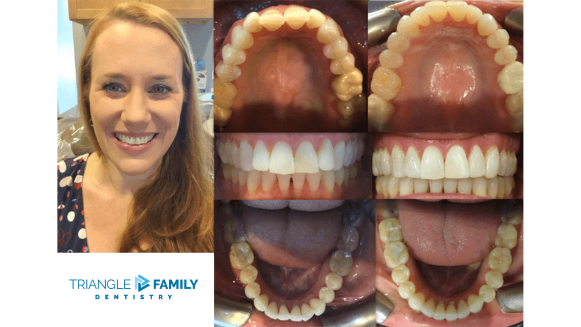 Smile Gallery - Before and After Dental Treatments at Triangle Family Dentistry