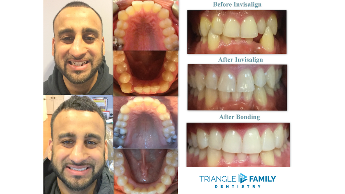 Smile Gallery - Before and After Invisalign and Bonding at Triangle Family Dentistry