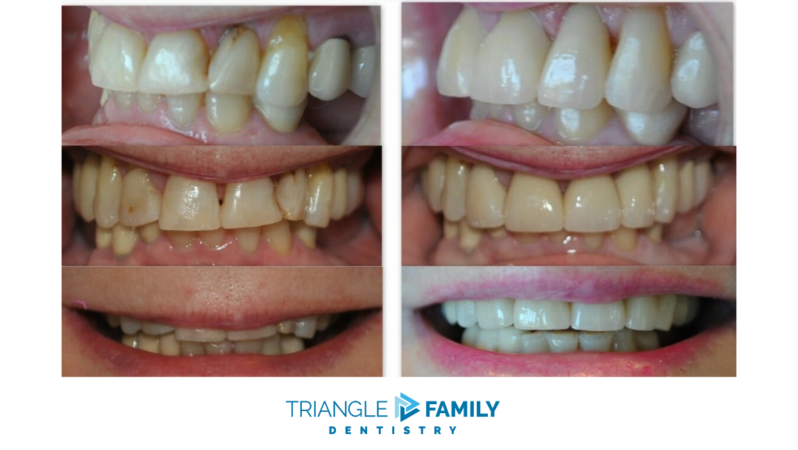 Smile Gallery - Before and After Dental Treatments at Triangle Family Dentistry