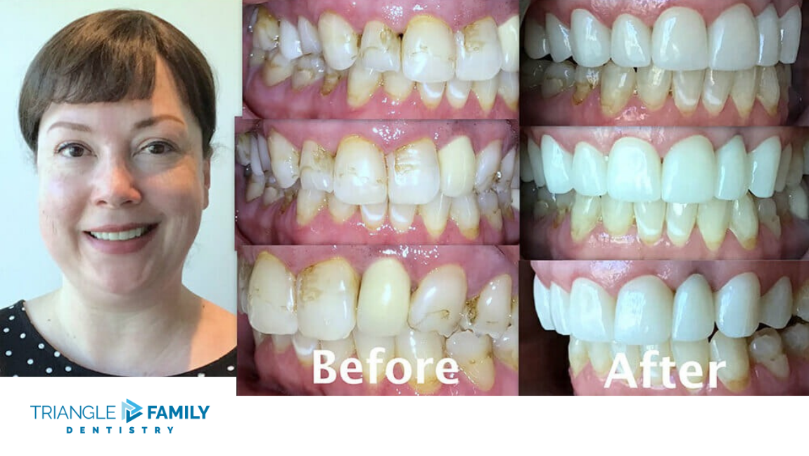 Smile Gallery - Before and After Dental Treatments at Triangle Family Dentistry