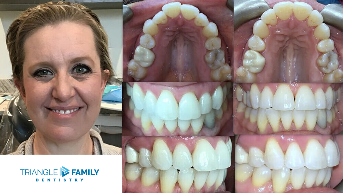 Smile Gallery - Before and After Dental Treatments at Triangle Family Dentistry