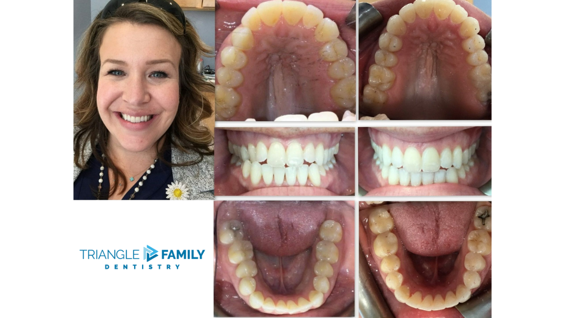 Smile Gallery - Before and After Dental Treatments at Triangle Family Dentistry