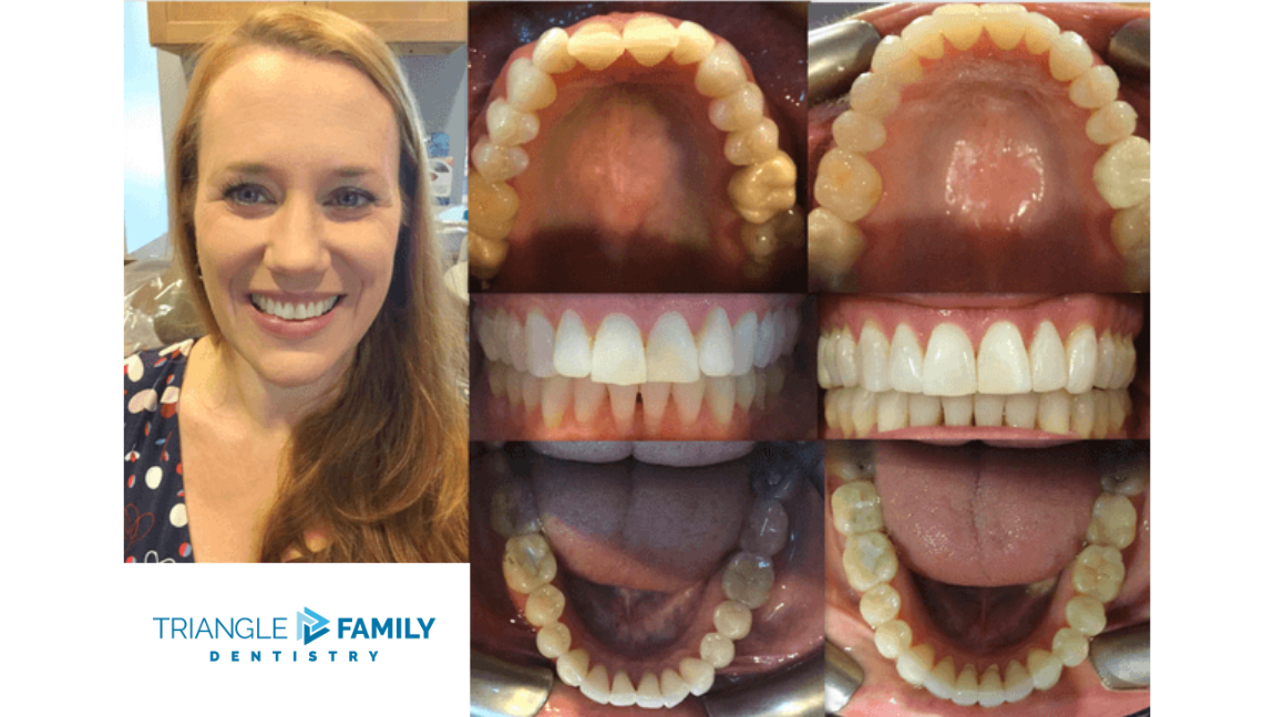 Smile Gallery - Before and After Dental Treatments at Triangle Family Dentistry