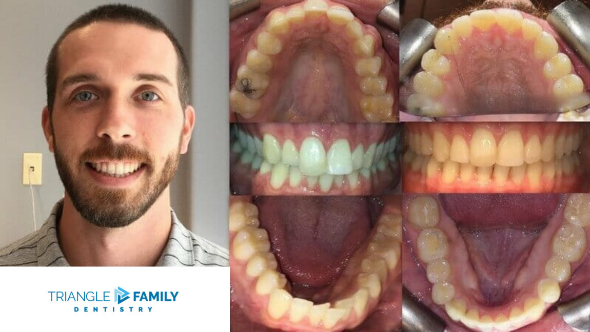 Smile Gallery - Before and After Dental Treatments at Triangle Family Dentistry