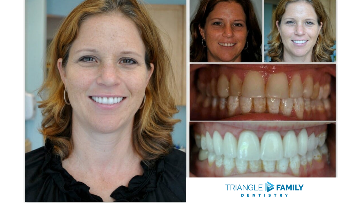 Smile Gallery - Before and After Dental Treatment at Triangle Family Dentistry