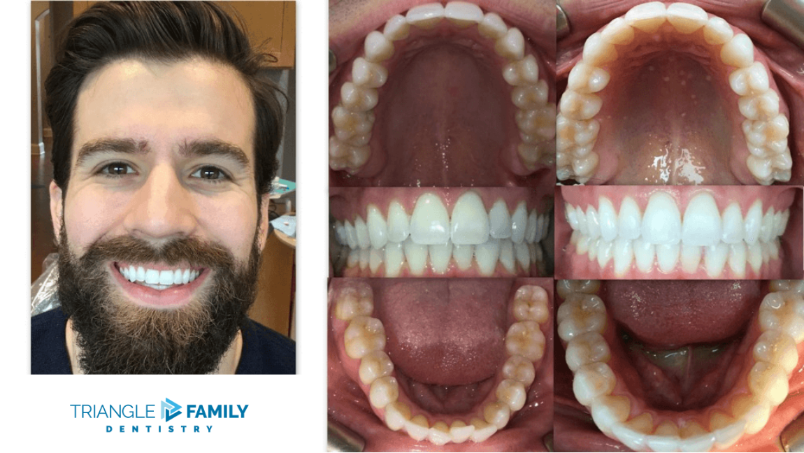 Smile Gallery - Before and After Dental Treatments at Triangle Family Dentistry