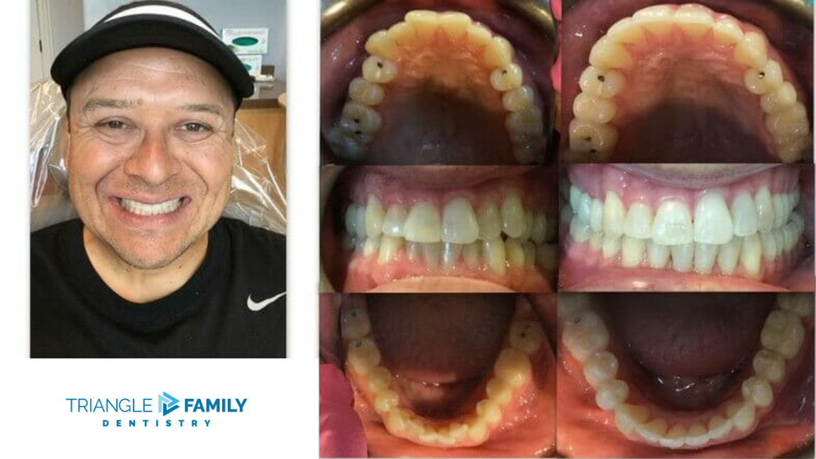 Smile Gallery - Before and After Dental Treatments at Triangle Family Dentistry
