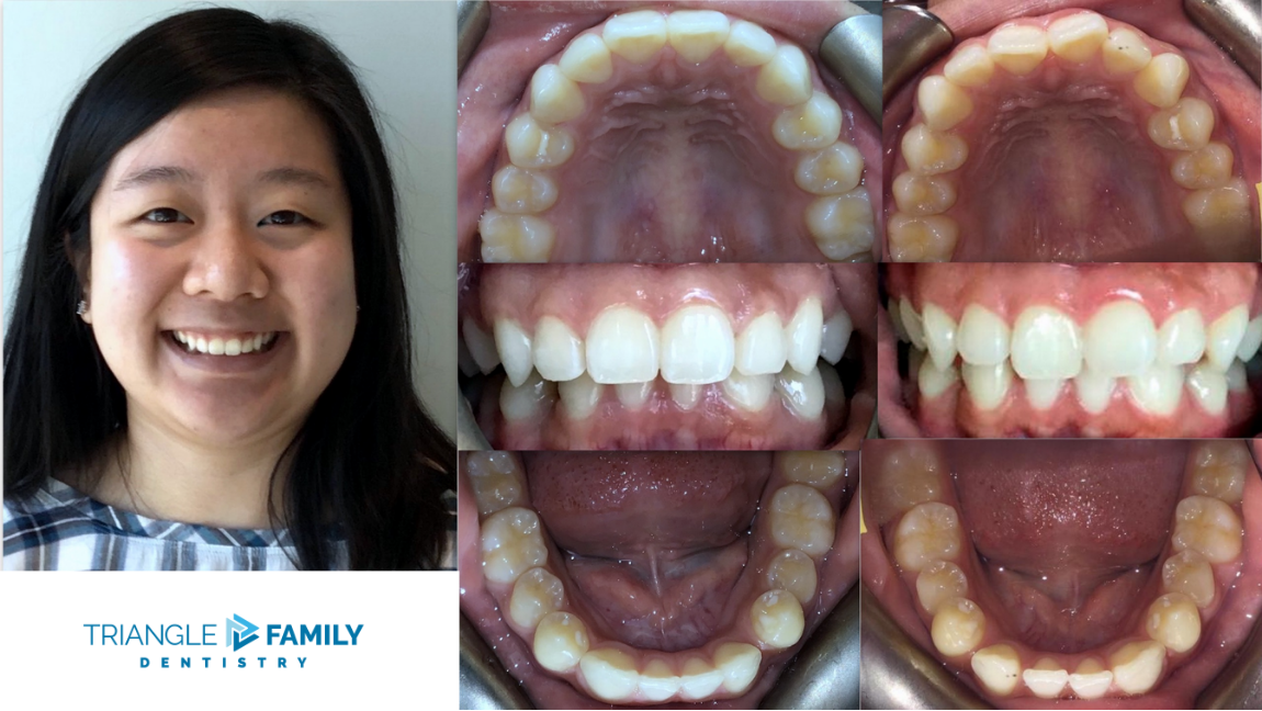 Smile Gallery - Before and After Dental Treatments at Triangle Family Dentistry