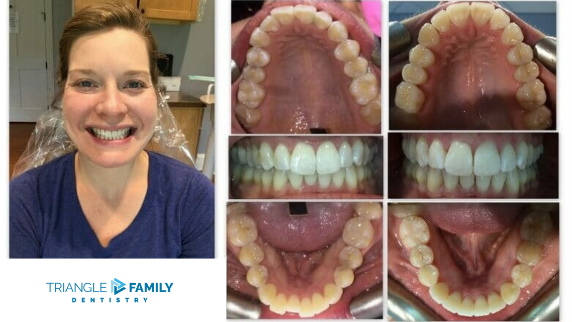 Smile Gallery - Before and After Dental Treatments at Triangle Family Dentistry