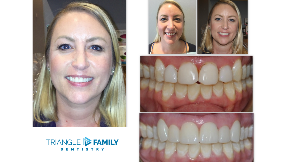 Smile Gallery - Before and After Dental Treatments at Triangle Family Dentistry