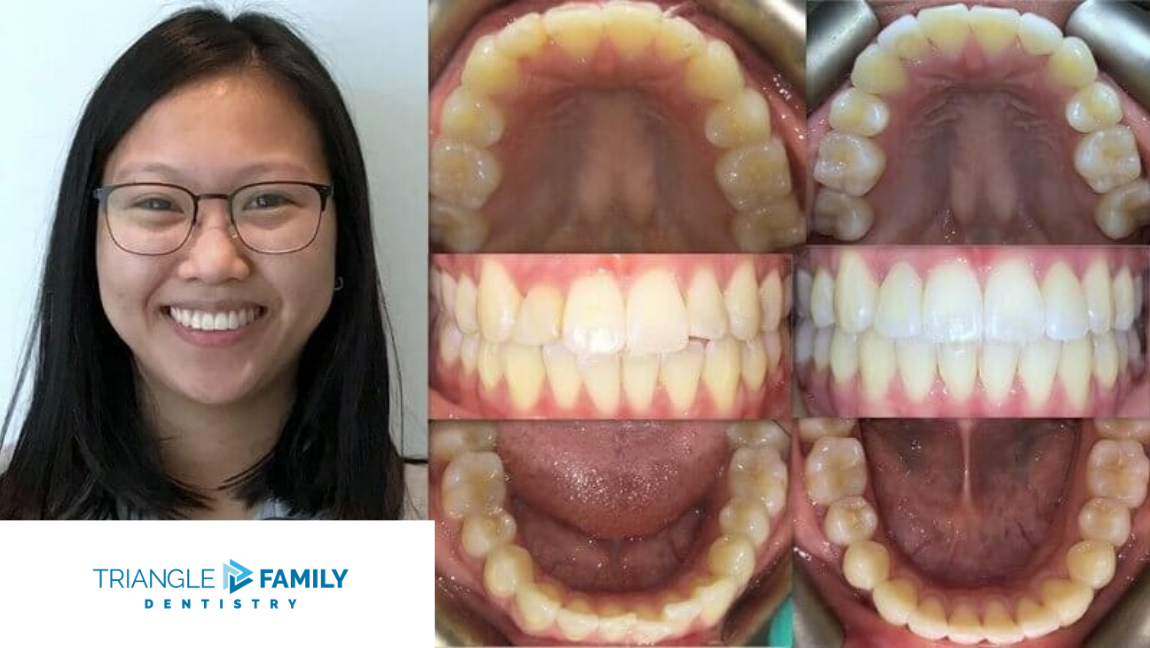 Smile Gallery - Before and After Dental Treatments at Triangle Family Dentistry