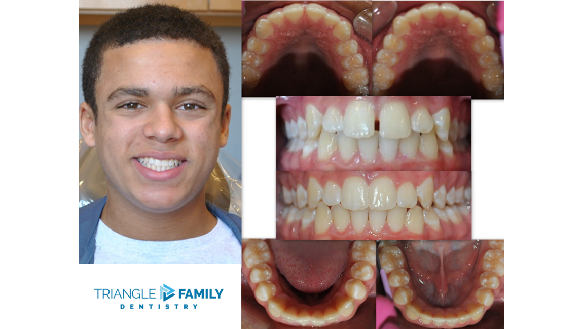Smile Gallery - Before and After Dental Treatments at Triangle Family Dentistry