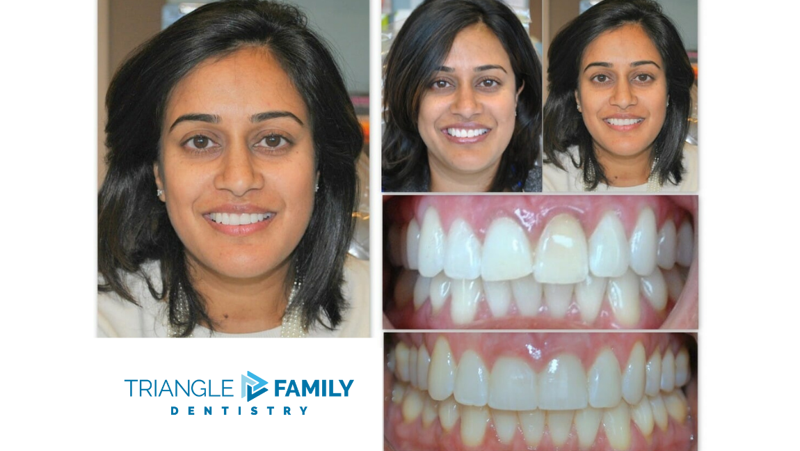 Smile Gallery - Before and After Dental Treatment at Triangle Family Dentistry