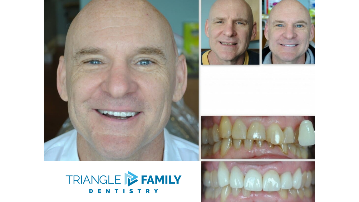 Smile Gallery - Before and After Dental Treatment at Triangle Family Dentistry