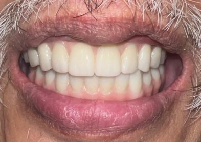 Teeth Xpress (After)