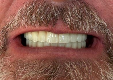Teeth Xpress (After)