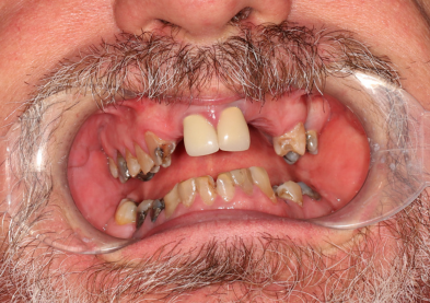 Teeth Xpress (Before)