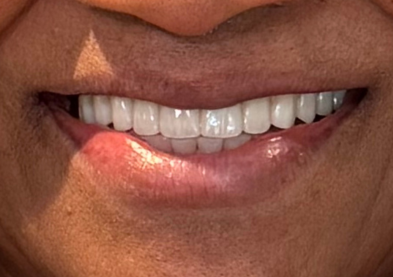 Teeth Xpress (After)