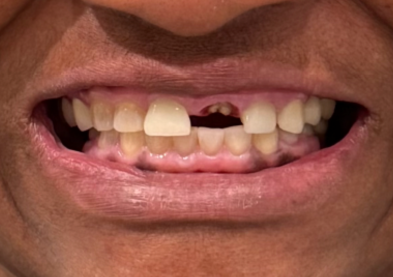 Teeth Xpress (Before)