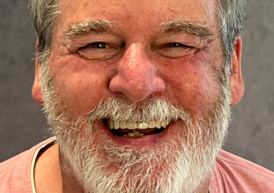 Teeth Xpress (After)