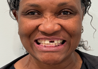 Teeth Xpress (Before)