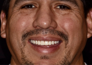 Teeth Xpress (After)