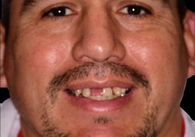 Teeth Xpress (Before)