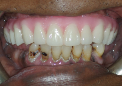 Teeth Xpress (After)