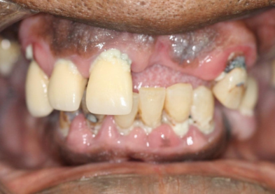 Teeth Xpress (Before)