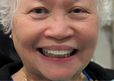 Teeth Xpress (After)